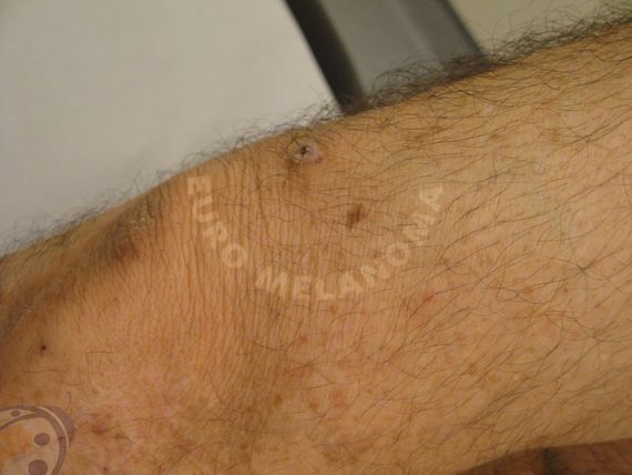 K ratose Verrue S borrh ique Euromelanoma